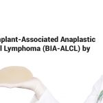Breast Implant-Associated Anaplastic Large Cell Lymphoma (BIA-ALCL) by the FDA