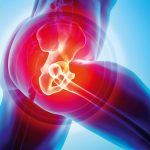 hip Arthroplasty
