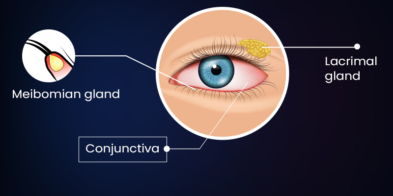 Medical illustration of eye inflammation highlighting potential ocular side effects associated with immunotherapy.