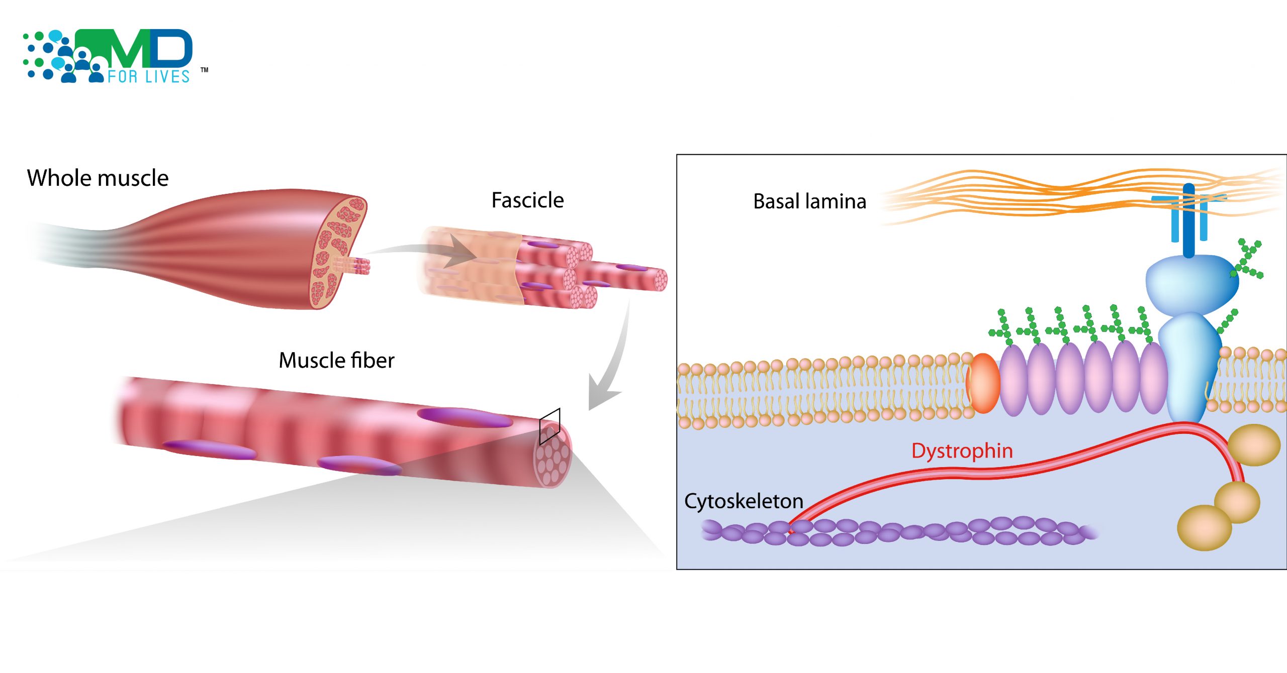 DMD Exon Skipping Therapy