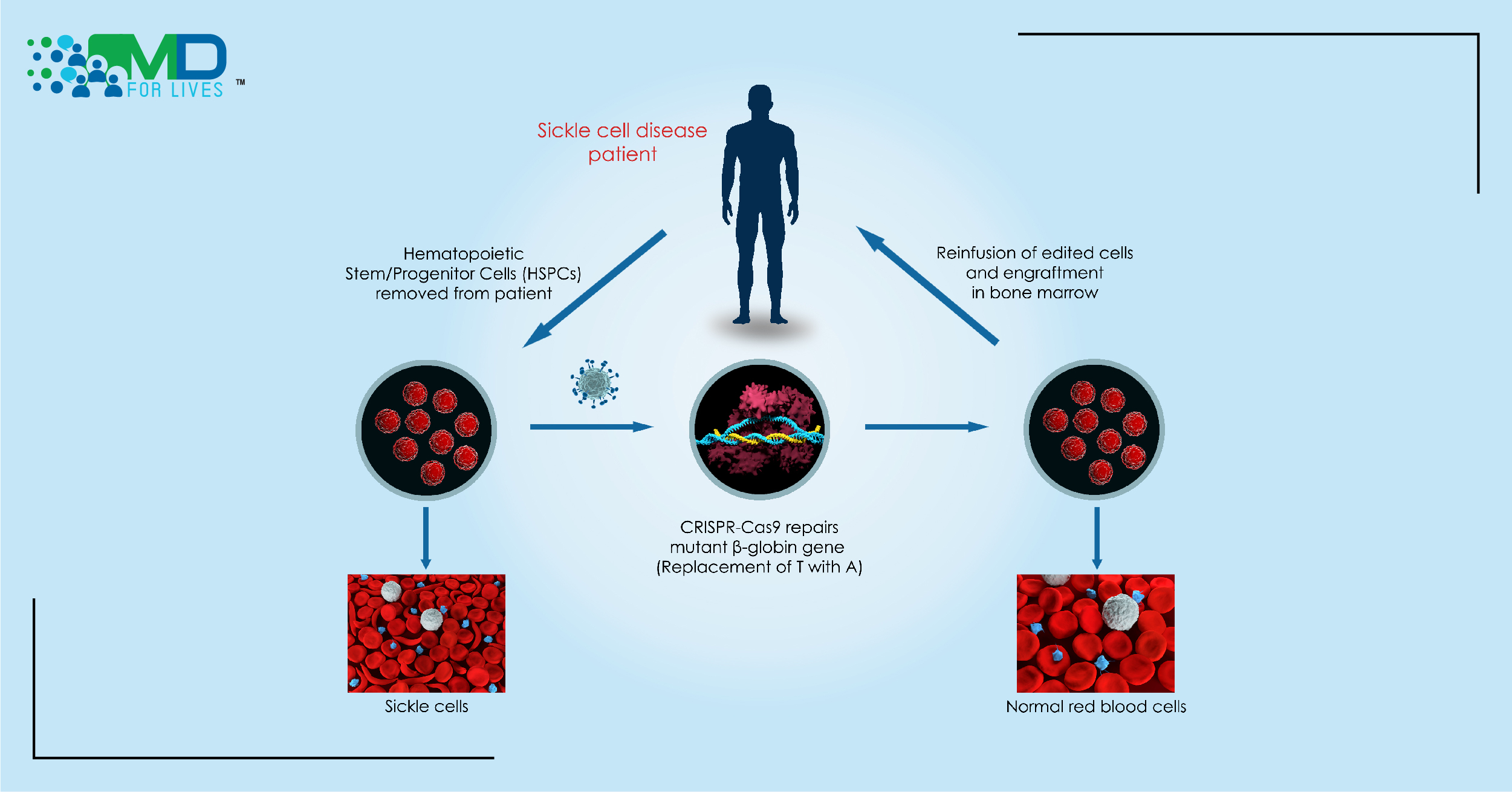 FDA Approves First Trial of CRISPR for Sickle Cell Disease