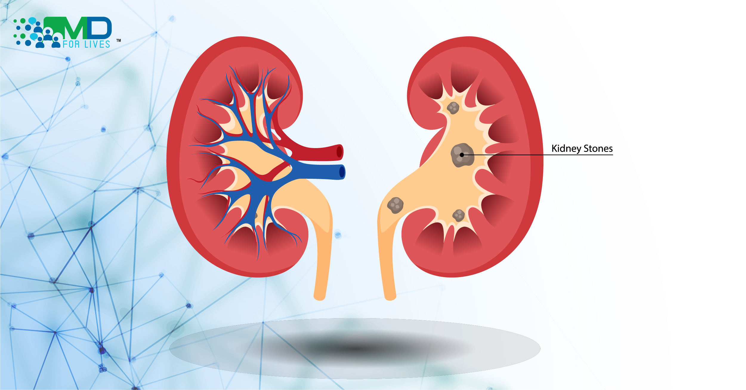 Recent Developments In Primary Hyperoxaluria Treatment