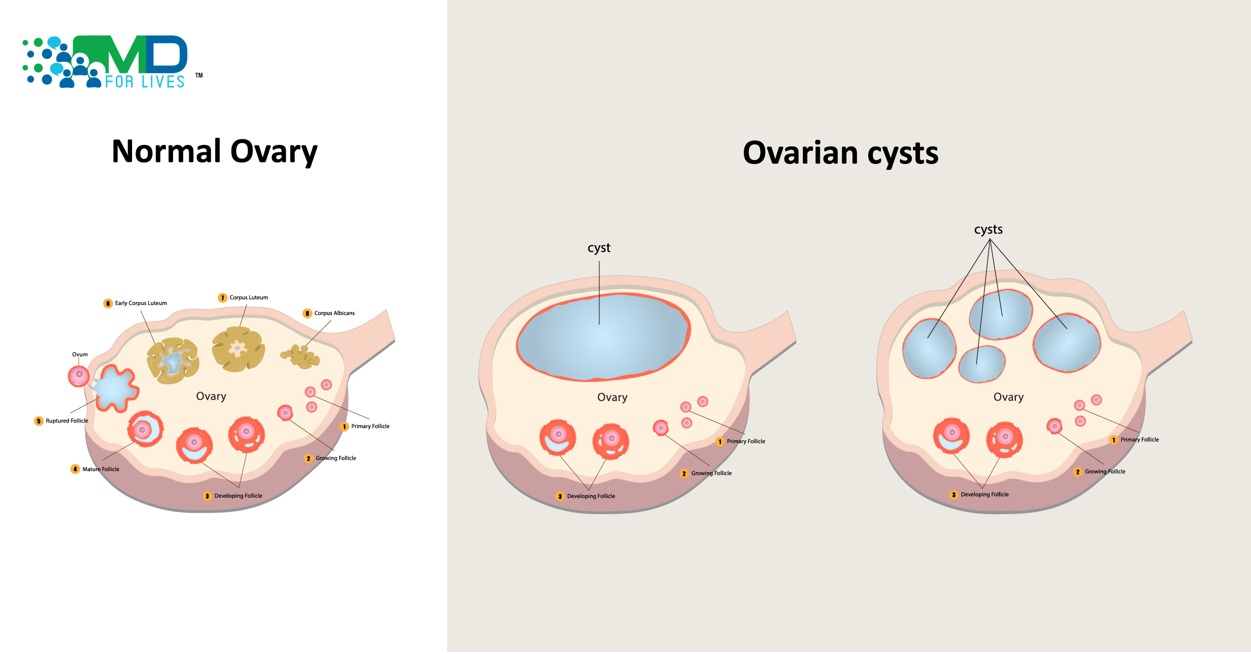 Normal Ovary vs Ovarian Cyst