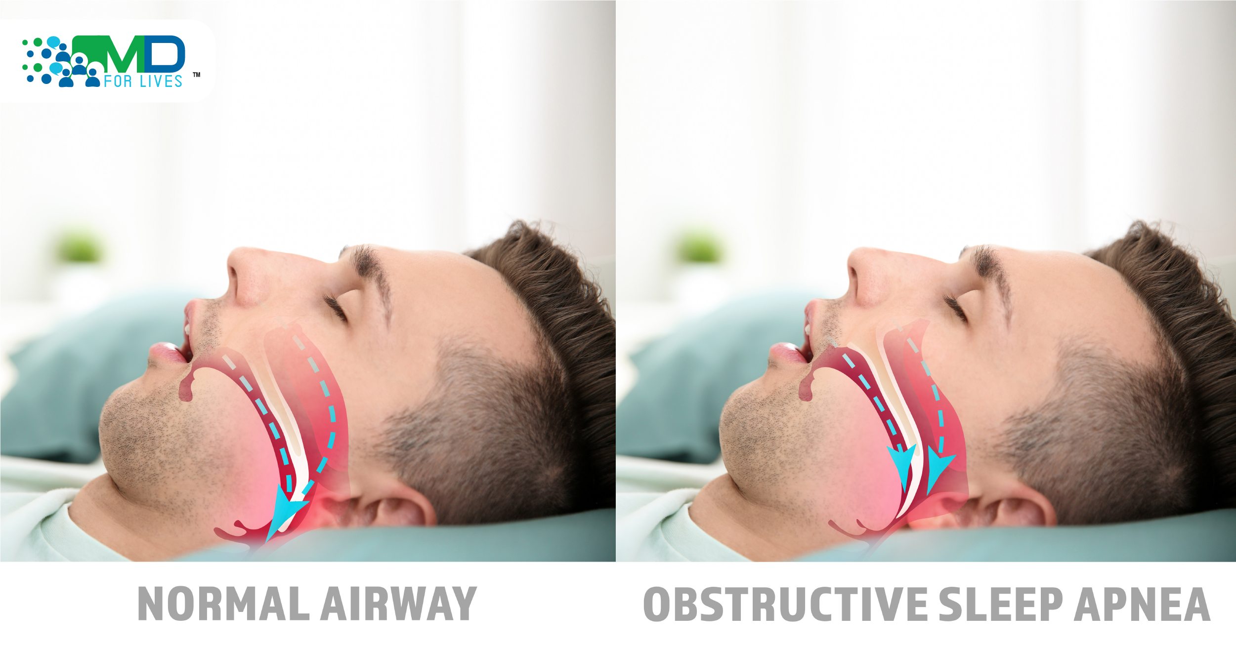 obstructive sleep apnoea