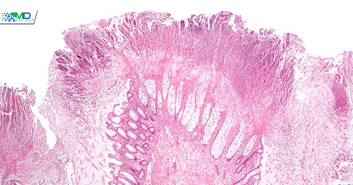 Pseudomembranous colitis