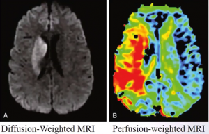 diffusion-weighted and perfusion-weighted MRI of a stroke patient