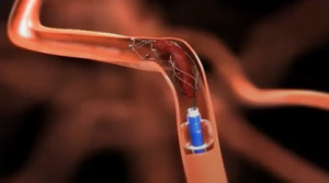Endovascular Recanalization