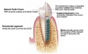 Implants in pediatric cases