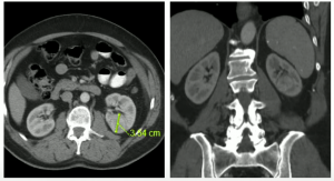 Decision making pathways around Nephron-Sparing Renal Surgery
