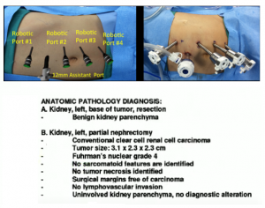 Decision making pathways around Nephron-Sparing Renal Surgery