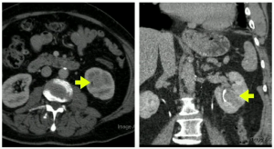 Decision making pathways around Nephron-Sparing Renal Surgery