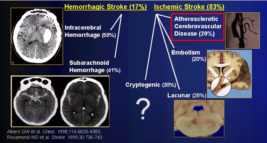 Hemorrhagic Stroke vs Ischemic Stroke