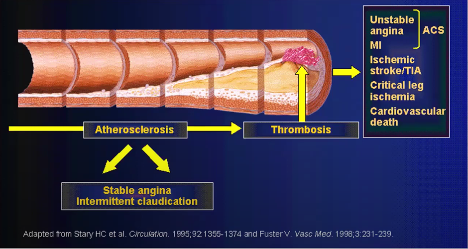 Ischemic Stroke