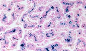 Hemochromatosis Screening and Awareness Month: research roundup