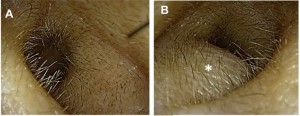 Can COVID-19-related Arterial Thrombosis be a possible cause of External Ear Canal Stenosis?