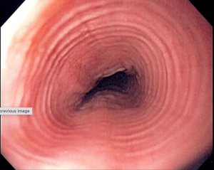 Dupilumab becomes the first FDA-approved drug for eosinophilic esophagitis