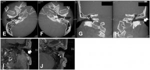Can COVID-19-related Arterial Thrombosis be a possible cause of External Ear Canal Stenosis?