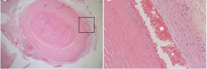 Management of external ear canal stenosis in COVID-19-treated patients Surgery was used to successfully treat the patient's bilateral external ear canal stenosis because the etiology was unknown. In order to reduce ear fullness and enlarge the external ear canal to enhance hearing, the surgeons conducted a resection for the left ear's external canal stenosis.   Under general anesthesia, more significant stenosis was seen when the outer ear canal was incised, and a spherical mass was encountered in the narrowest region of this canal. It was simple to separate from the surrounding subdermal tissues, and the perichondrium from the tragus was applied to the external canal's exposed bony wall and fixed with fibrin glue. After a 6 month followup, the patient's left ear external canal was found much wider than before the surgery.  What did the biopsy reveal? The biopsy results assisted in excluding neoplastic lesions or other benign tumors as potential causes of external ear canal stenosis. The excised tissue was mainly composed of a thrombosis that developed in the artery, according to the histopathological examination. the combined clinical and histological results concluded that the mass brought on by a COVID-19-related arterial thrombosis of the external ear canal was indicated to have induced an external ear canal stenosis.