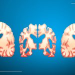 Decoding The Subtypes Of Alzheimer’s Disease