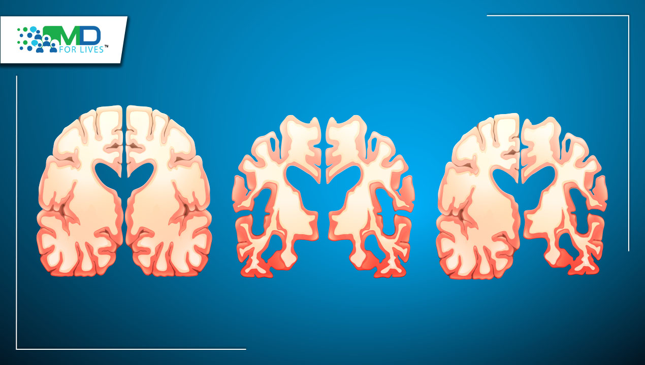 Decoding The Subtypes Of Alzheimer’s Disease