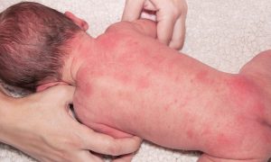 Vitamin D supplementation in pregnancy reduces the incidence of infantile atopic eczema