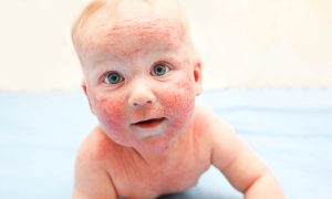 Vitamin D supplementation in pregnancy reduces the incidence of infantile atopic eczema
