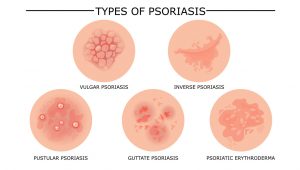 Psoriasis Action Month: Research Highlights