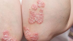 Psoriasis Action Month: Research Highlights