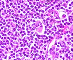 Hodgkin’s lymphoma