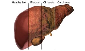 RNAi therapy under investigation in a genetic liver disease
