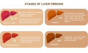 RNAi therapy under investigation in a genetic liver disease