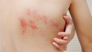 varicella-zoster virus