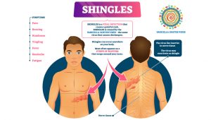 What is shingles