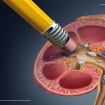 Should asymptomatic kidney stones be removed during endoscopy