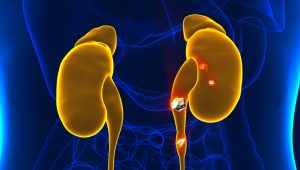 Primary kidney stones