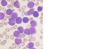 Acute lymphoblastic leukemia