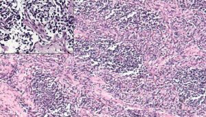 Rhabdomyosarcoma tumor cells