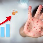Shingles rates and the COVID-19 pandemic