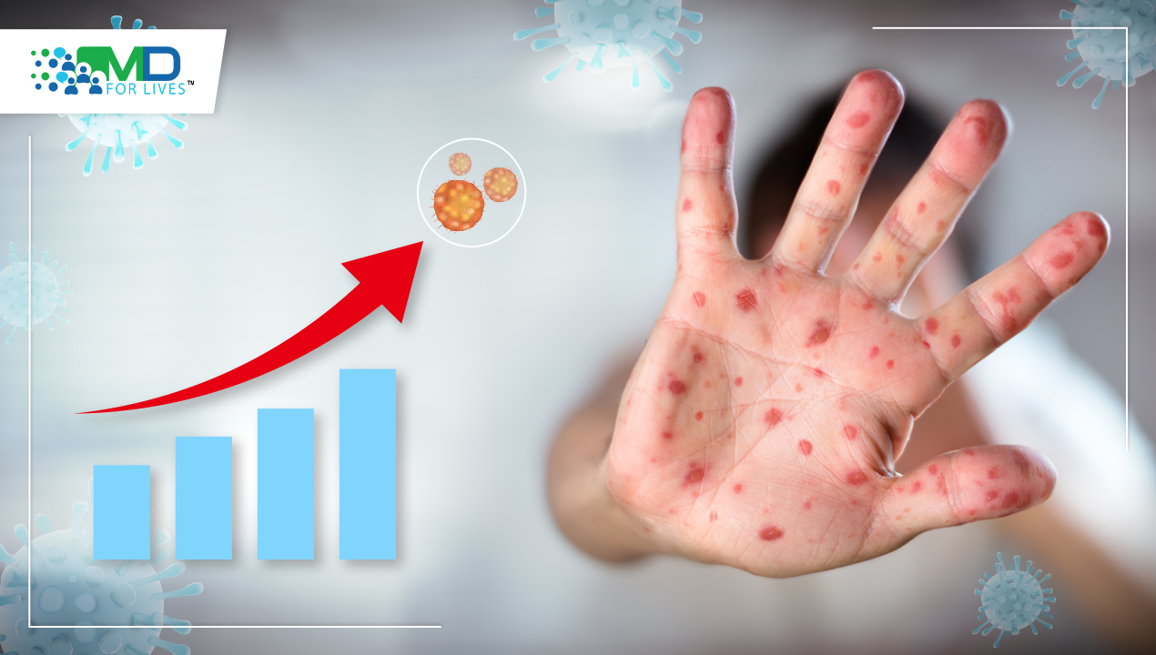 Shingles rates and the COVID-19 pandemic