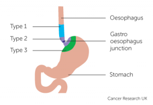 esophago-gastric junction (OGJ)