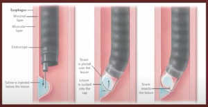 prevention of malignancy