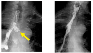 cervical anastomotic leak