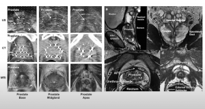 Innovation in brachytherapy