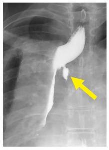 radiological intra-thoracic Type 1 leak