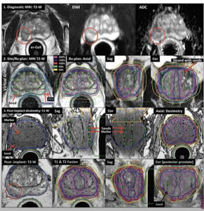 Innovation in brachytherapy