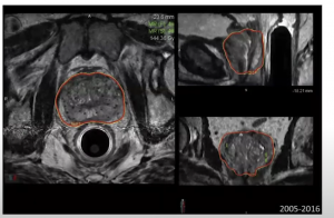 Value and future of brachytherapy: