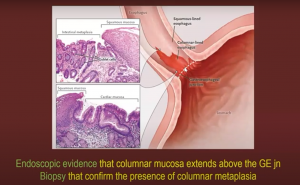 GE junction tumors