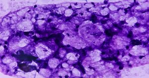 Breast lump biopsy