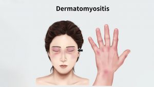 dermatomyositis
