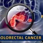 New paradigms in Colorectal Cancer – Part 2